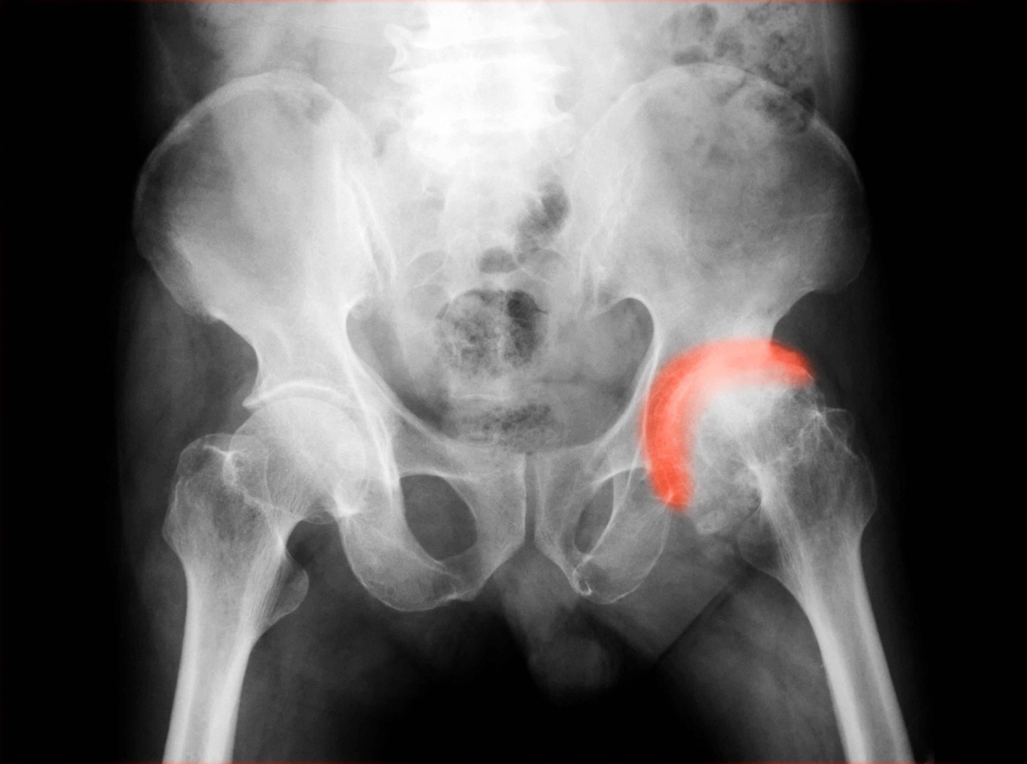 你知道“股骨头坏死”？这5个病因请你重视，否则易致瘫痪！