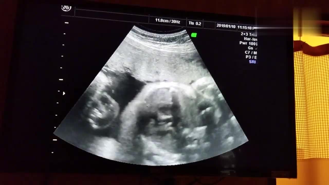 怀孕31周产检做四维彩超过程实录,可以清楚的看到宝宝的模样!