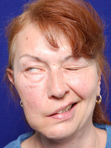 眼皮总跳或许是面肌痉挛信号不重视有可能眼睛都没法睁开