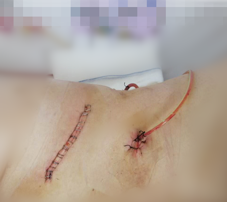 烟台海港医院泌尿外科——微创解决"大"问题|肾盂肿瘤|泌尿|手术_新浪