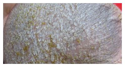 什么原因会导致新生儿的头上有污垢