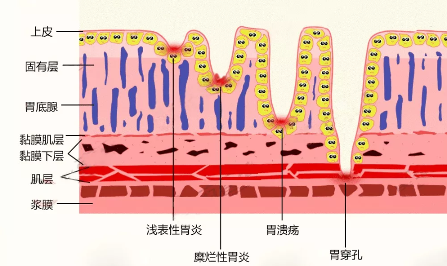 做好4件事,糜烂性胃炎不会找上你|胃溃疡|糜烂性胃炎|黏膜_新浪新闻