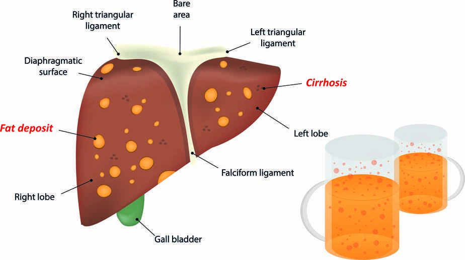酒精肝为何如此致命?...