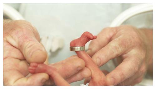 245克早产儿如何活下来?原因很震撼,拒绝早产从孕检开始