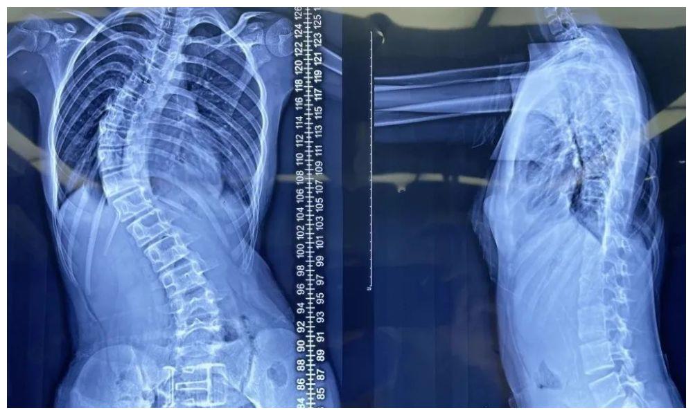 脊柱侧弯|脊柱|婷婷_新浪新闻