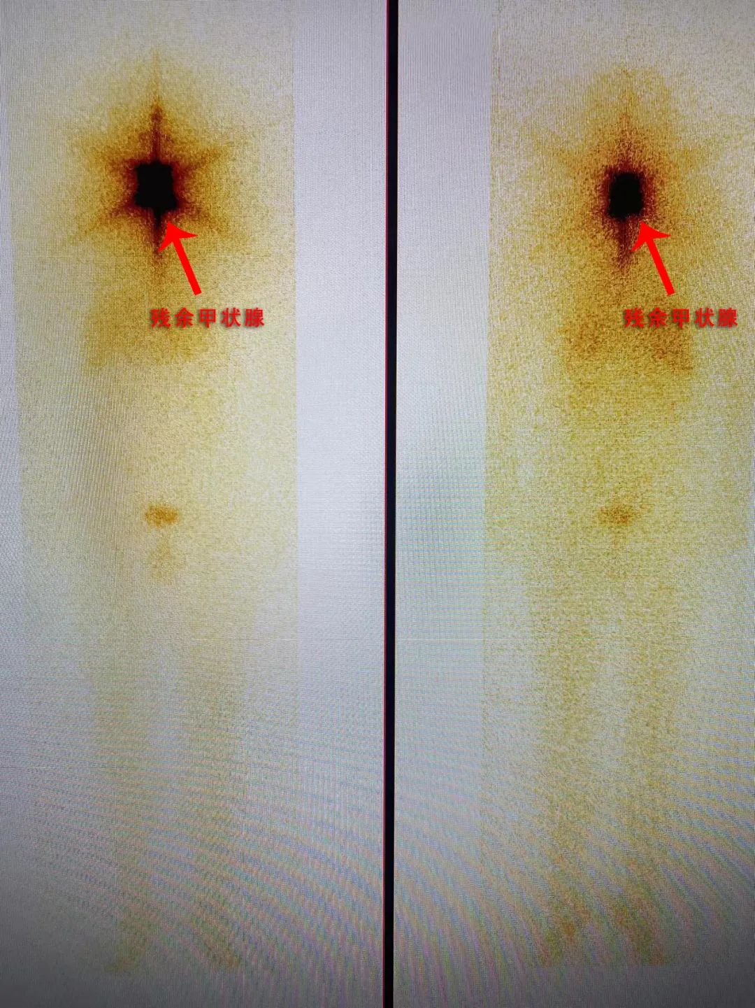 王女士全身碘扫图像患者留言碘-131治疗是原子能在医学科学领域和平