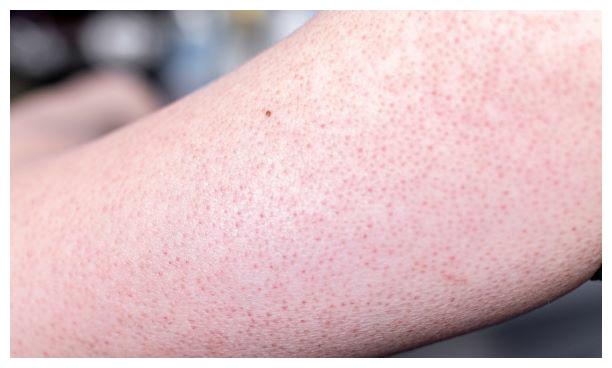 小儿鸡皮肤缺什么维生素(小儿鸡皮肤缺什么维生素B) 小儿鸡皮肤缺什么维生素(小儿鸡皮肤缺什么维生素B)