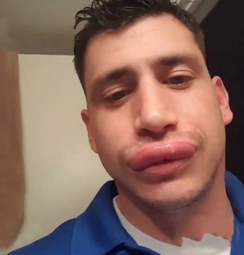 男子觉得自己嘴唇不够性感,抓黄蜂来蛰变香肠嘴