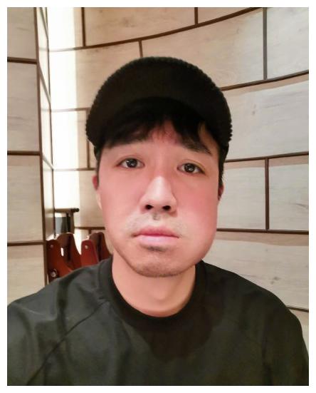 俞灏明脸肿如瓜发文求助,引网友心疼:意外毁了明日之星!