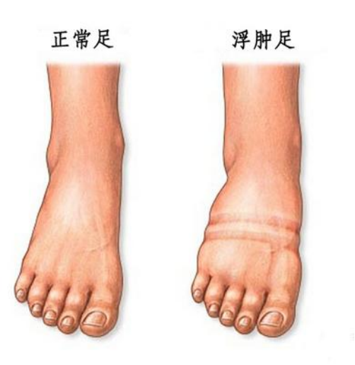 男子双脚肿胀查出尿毒症__财经头条