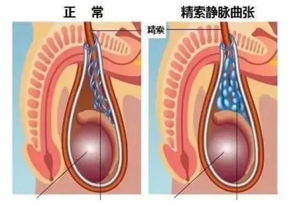 正确认识男性疾病 精索静脉曲张