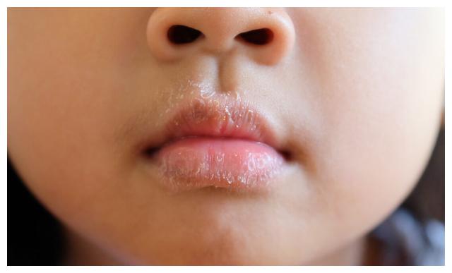 一位高中同学也有这样的习惯,总爱不自觉的咬,撕嘴皮,嘴唇总是有裂缝.