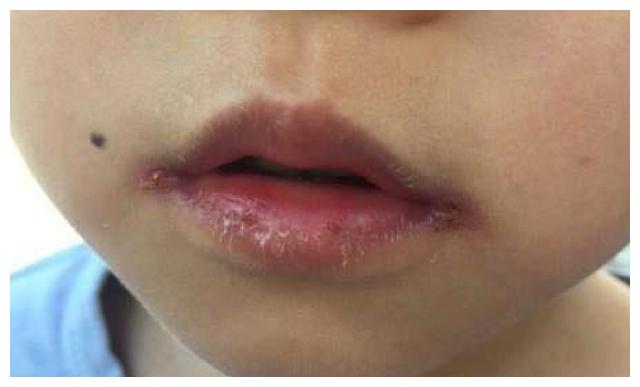 小孩经常撕嘴是干涩还是强迫症两者的对策不同要了解