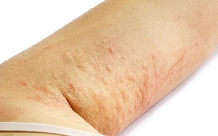 荨麻疹俗称风疹块,是一种常见的皮肤病,是由皮肤反应引起的红色瘙痒