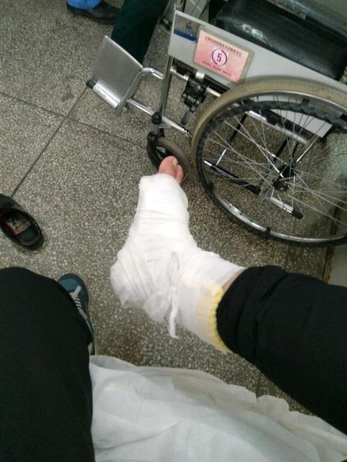 踝关节骨折能恢复如初吗?术后康复治疗很关键