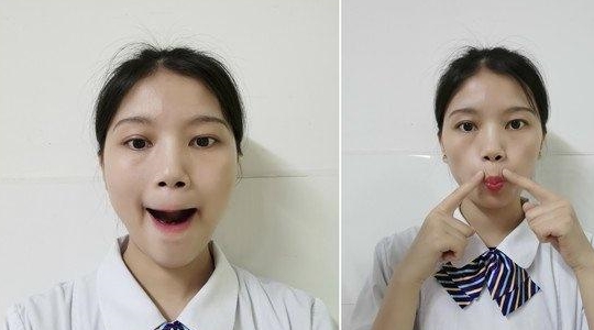 26岁小伙风扇吹一夜变面瘫美小护教六步鬼脸操促康复