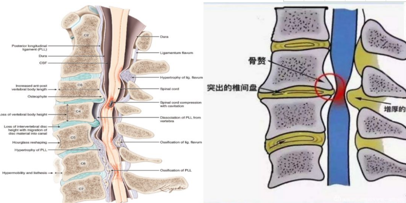 颈椎病术后复发治疗去哪里好?仁济骨伤孟繁春治可以治好吗?
