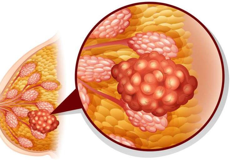 1,乳房肿块想要判断乳腺是否健康,生活中可以自查乳房的状况,若是单侧