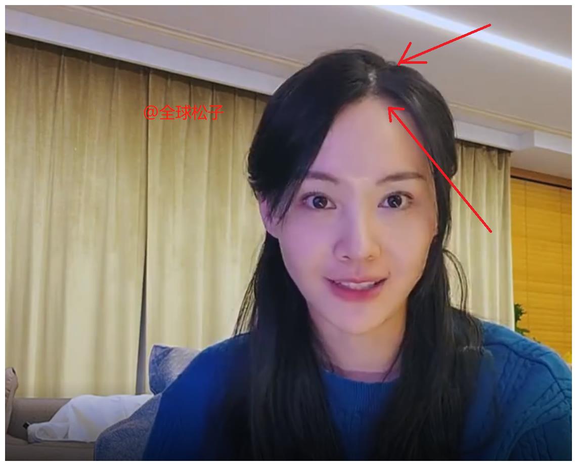 从视频中还可以看出,郑爽的发量是真的不太多,头顶头发稀疏,发际线