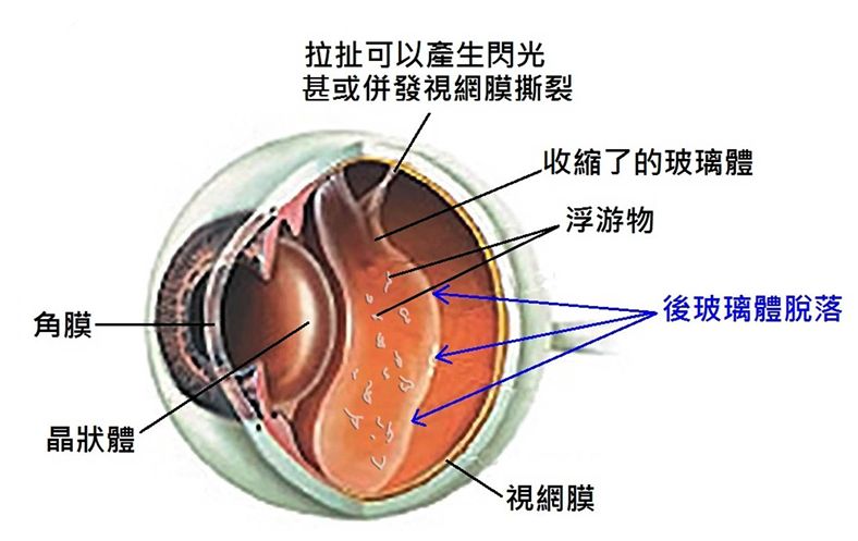 葡萄膜炎|玻璃体|飞蚊_新浪新闻
