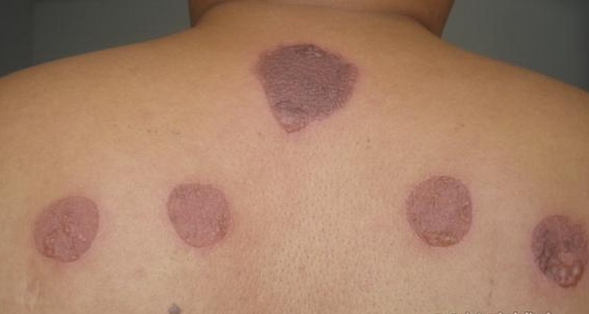 其实三伏贴也叫做发泡灸,这种临床上的发泡灸,是皮肤的发泡,有些病从