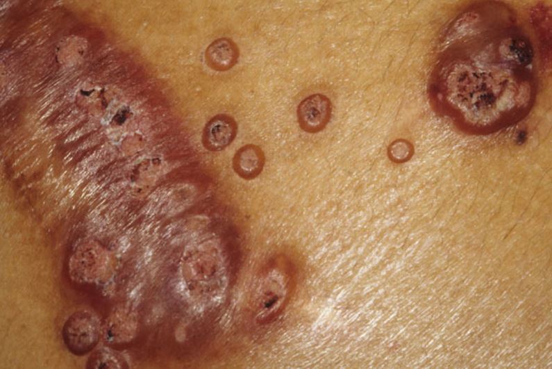 发现使卡波西肉瘤疱疹病毒处于休眠状态的细胞蛋白