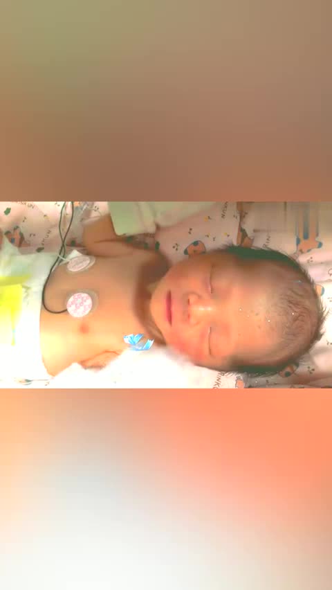 刚刚出生的35周早产儿宝宝睡觉时受到一点干扰就会有惊跳反射