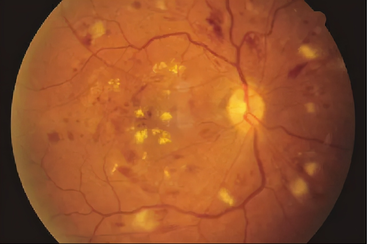 爱眼底|头号致盲杀手黄斑病变,患病只能等失明?