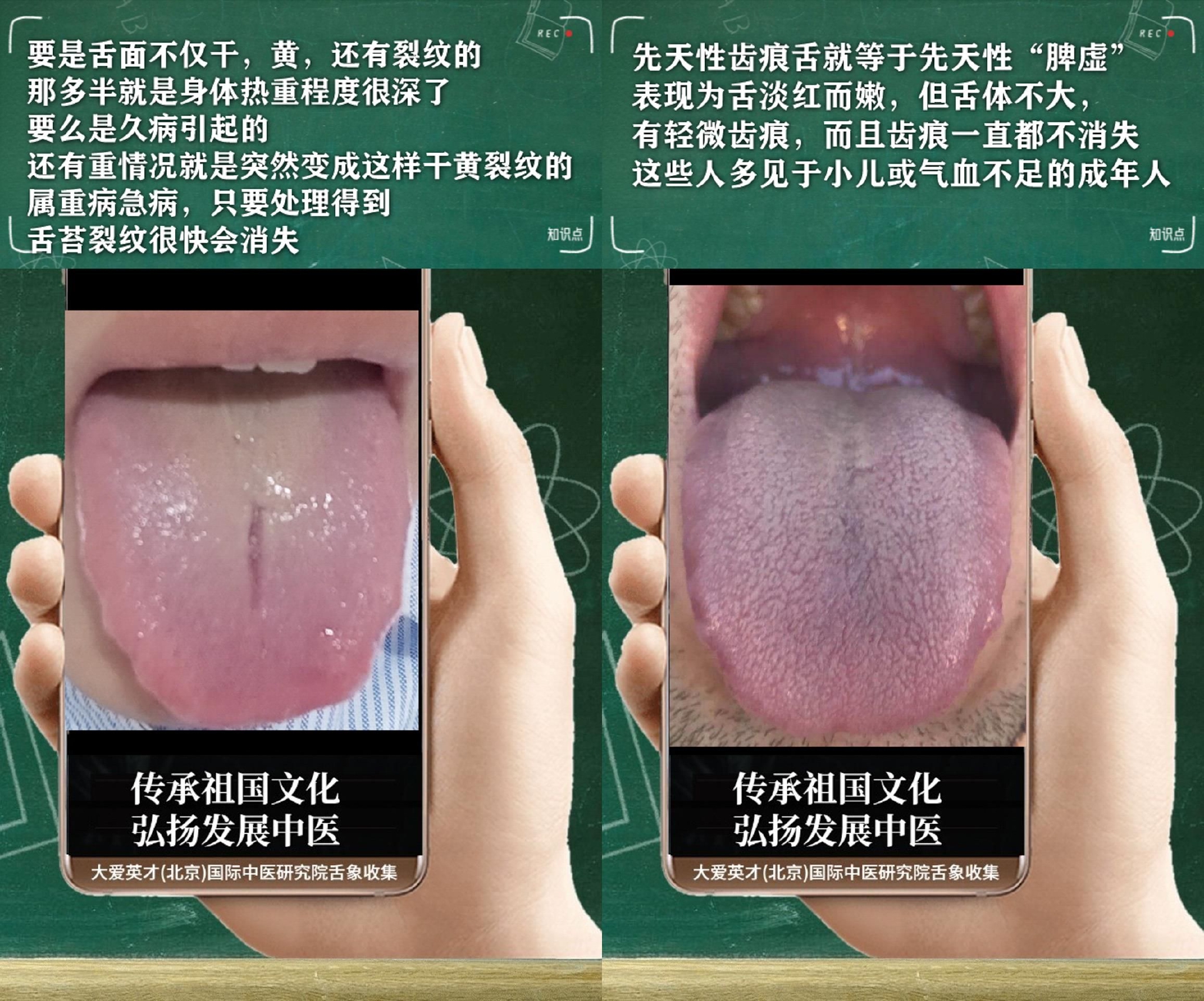 舌诊解剖:易内心不安、消瘦无力、湿热下注、容易犯病很绝望|结肠|浊气|两头尖|海龙|商陆_新浪新闻