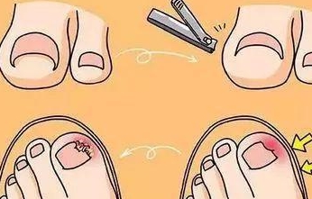 8岁男孩指甲被连根拔除,专家说很多家长剪指甲的方式都错啦|甲沟炎