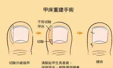 8岁男孩指甲被连根拔除专家说很多家长剪指甲的方式都错啦