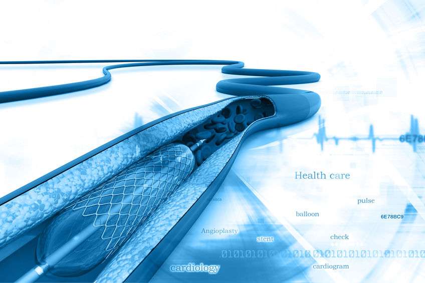 心脏支架到底是什么?它对寿命有何影响?医生给的分析,不妨看看休闲区蓝鸢梦想 - Www.slyday.coM 心脏支架到底是什么?它对寿命有何影响?医生给的分析,不妨看看休闲区蓝鸢梦想 - Www.slyday.coM