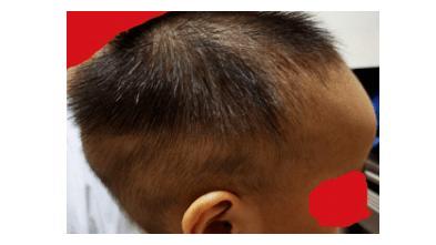 宝宝长出橄榄球状头3d打印助狭颅症患儿重建颅骨