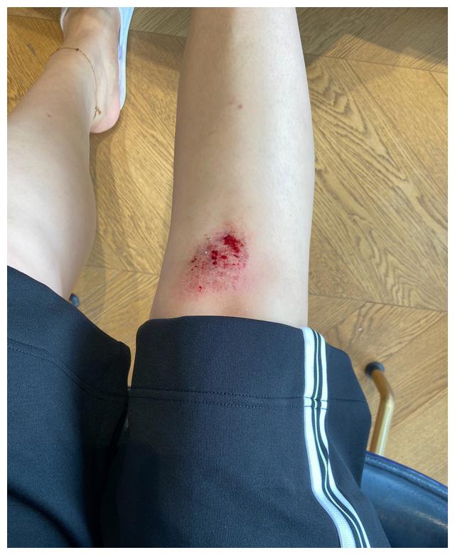 王一梅晒出两张照片疑似训练摔破膝盖32岁老将竟如此拼感动