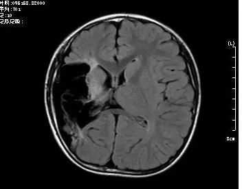 右侧颞叶软化灶图片