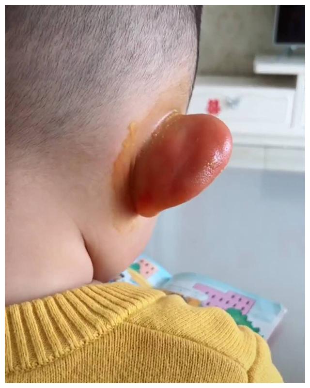宝宝两只耳朵都被蚊子"光顾",化身大耳朵图图,妈妈看了很心疼