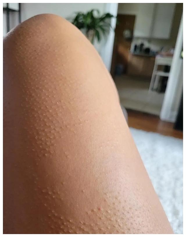 女生被亲会起鸡皮疙瘩(为什么被亲会起鸡皮疙瘩) 女生被亲会起鸡皮疙瘩(为什么被亲会起鸡皮疙瘩)