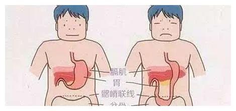 西安东大肛肠医院丨如何预防胃下垂