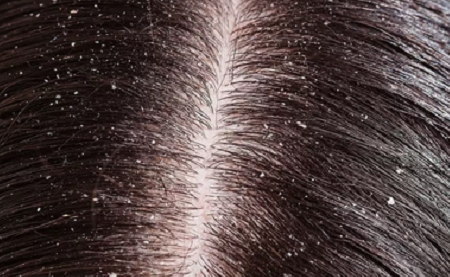 头皮干燥头屑多用什么洗发水 十大公认最好用的洗发水推荐