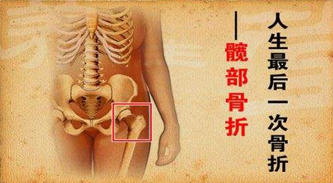 人生最后一次骨折髋部骨折生活中我们如何保养好髋关节