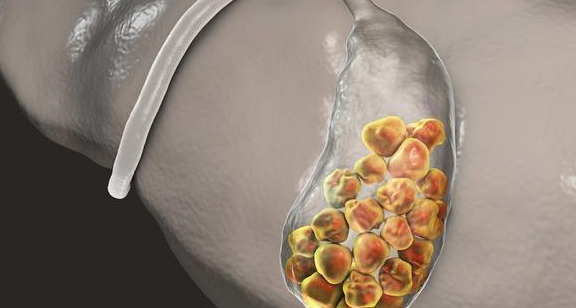 了解胆结石形成10个原因让我们尽快恢复正常生活