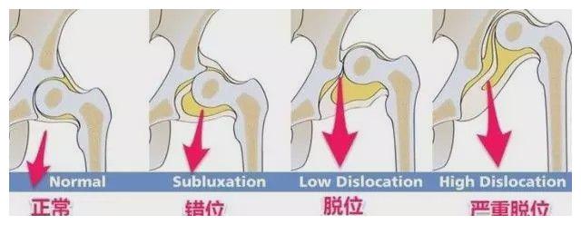 什么是髋关节发育不良