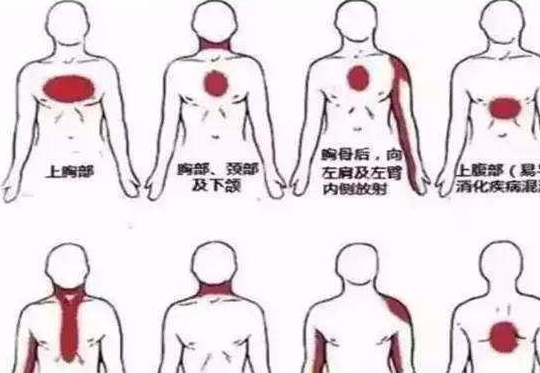 那疼痛位置不固定,还有不是疼痛的表现,我们如何判断是不是心绞痛呢?