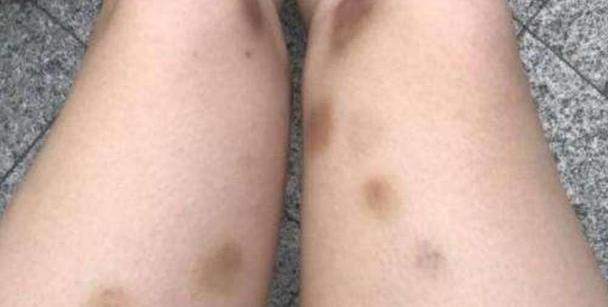 其中有一处皮肤还青紫相间,这明显就是被人打和掐留下来的痕迹.