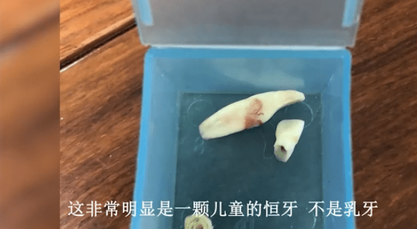 医生将女孩恒牙当乳牙拔错儿童蛀牙4个因素未必是吃糖