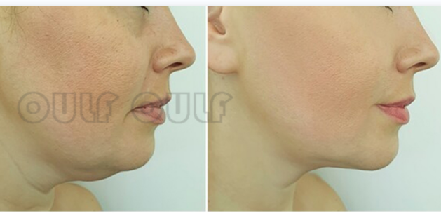 做超声刀前要注意什么,做超声刀后吃辣会怎样,别瞎整!休闲区蓝鸢梦想 - Www.slyday.coM 做超声刀前要注意什么,做超声刀后吃辣会怎样,别瞎整!休闲区蓝鸢梦想 - Www.slyday.coM