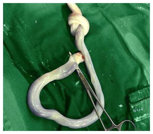 孕8月胎动突然消失,紧急剖腹产时,医生发现脐带扭得像"麻花"