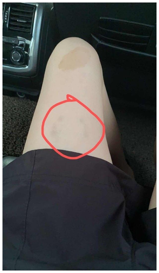 这么快就忘记池子了豆得儿让马頔咬大腿还将牙印照发到网上