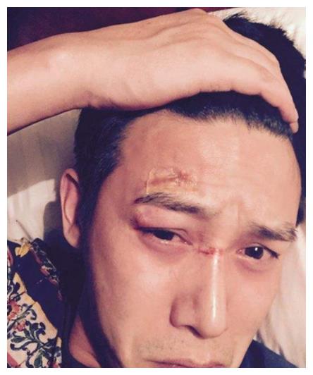 明星受伤惹争议,谢楠骨折,吴京被传"打老婆",于朦胧超敬业