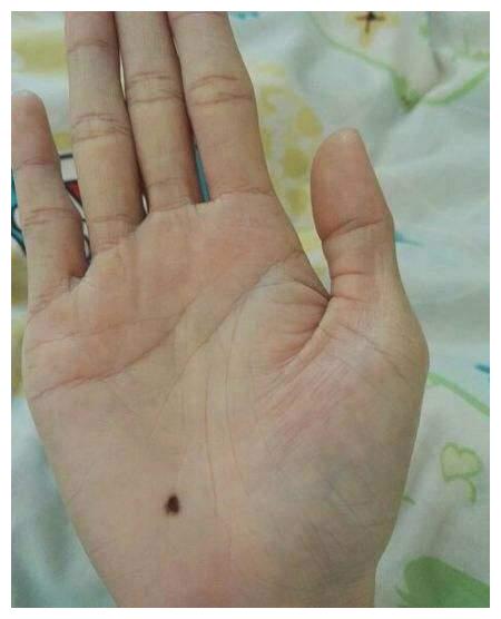 手上有一物不是贵就是富手掌有痣解读运势你有这颗痣吗